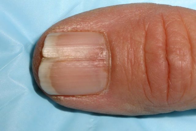 Ongles qui se dédoublent : Causes et solutions